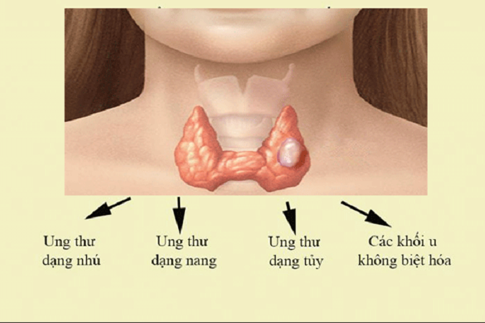 Ung thư tuyến giáp