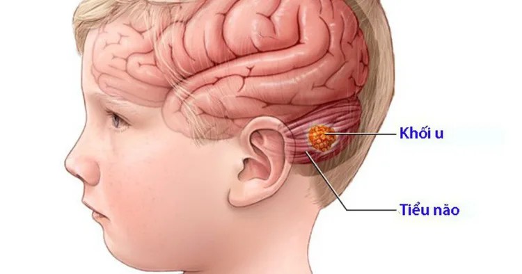 Tỷ lệ sống u não