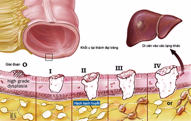 Giai đoạn của ung thư đại trực tràng