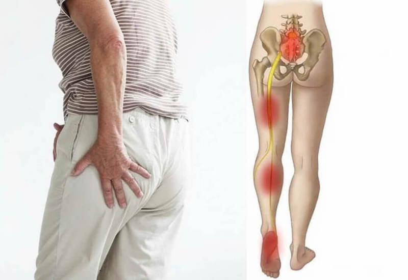 Đau thần kinh kéo dài, âm ỉ