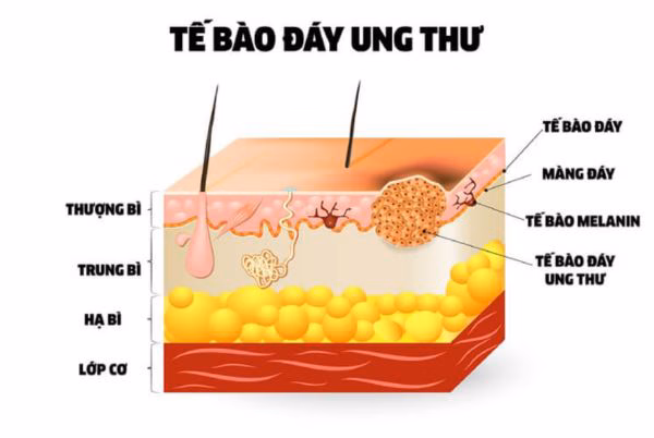 Ung thư biểu mô tế bào đáy