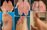 tác dụng phụ hóa chất